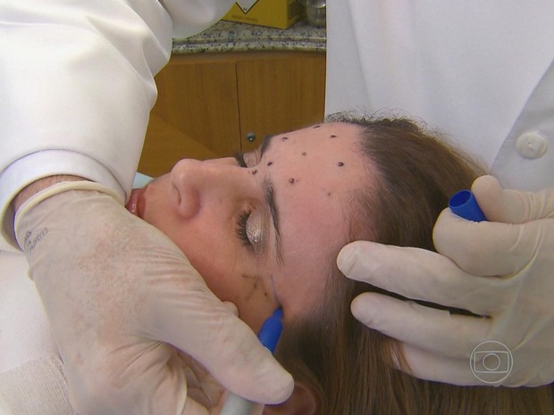 bdpe_170713_botox-jovens