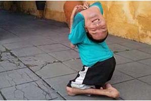 Claudio-nasceu-com-artrogripose-congênita