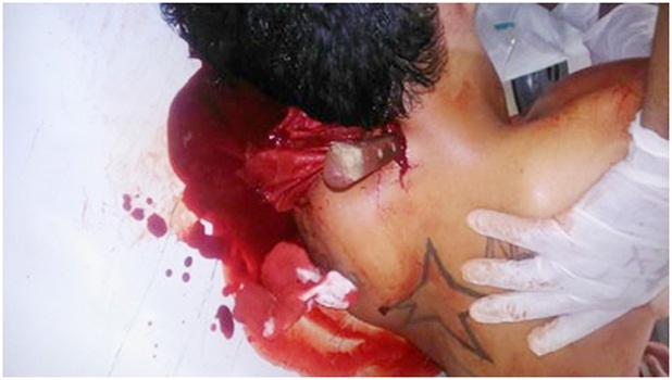 Jovem com faca encravada na nuca