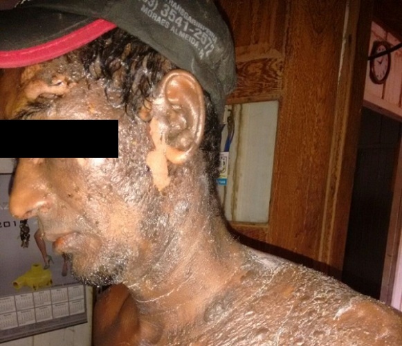 Após briga, mulher teria esquentado água para agredir marido (Foto: Rep./Blog do Junior Ribeiro)