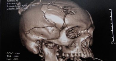 Imagem mostra o estrago que a bala fez na cabeça do Jovem