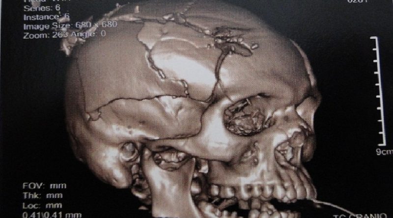 Imagem mostra o estrago que a bala fez na cabeça do Jovem