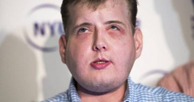 saucc81de-patrick-hardison-tansplante-rosto