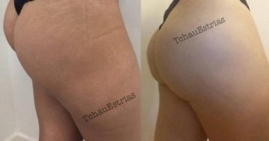 tatuador-brasileiro-que-camufla-estrias-faz-sucesso-internacional