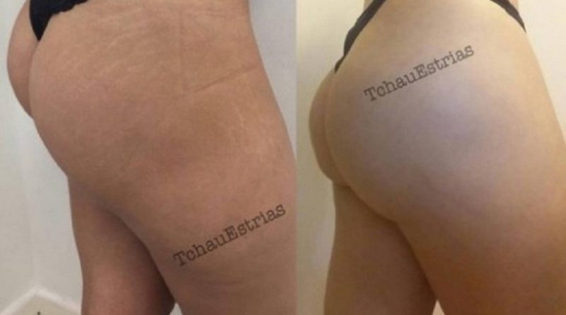 tatuador-brasileiro-que-camufla-estrias-faz-sucesso-internacional