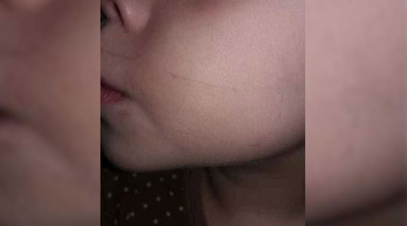 destaque-537448-esparadrapo