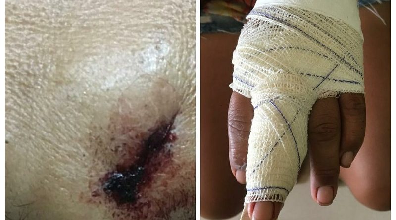 vitimas-de-lesao-corporal-leve