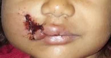 menina-ferida-maraba