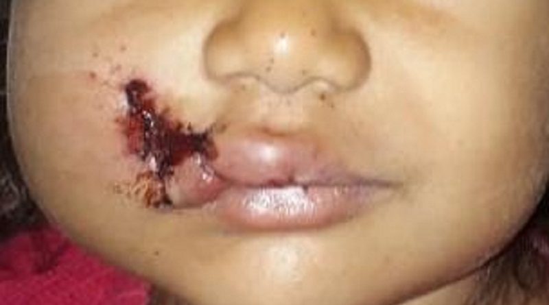 menina-ferida-maraba