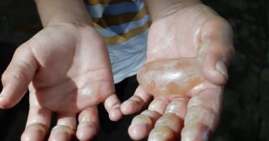 criança-mãos-queimadas-Foto-Jucélio-Paiva-1024x710