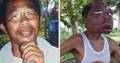 sinusite1_00530225_0_