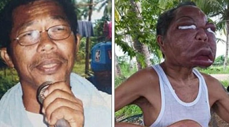 sinusite1_00530225_0_