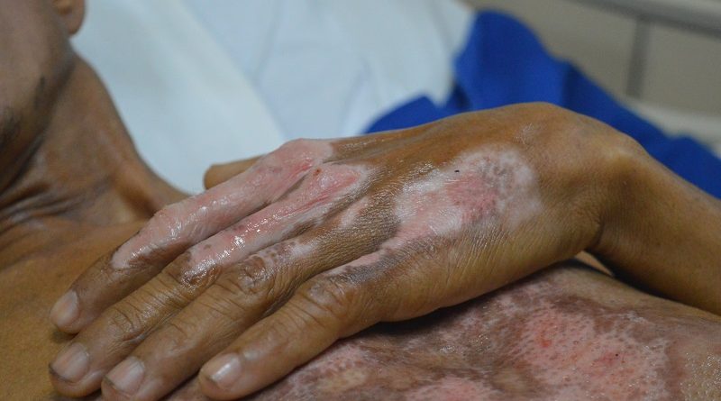 As marcas do acidente no corpo do mestre de obras, Uilton Oliveira. Foto Comunicação Pró-Saúde.