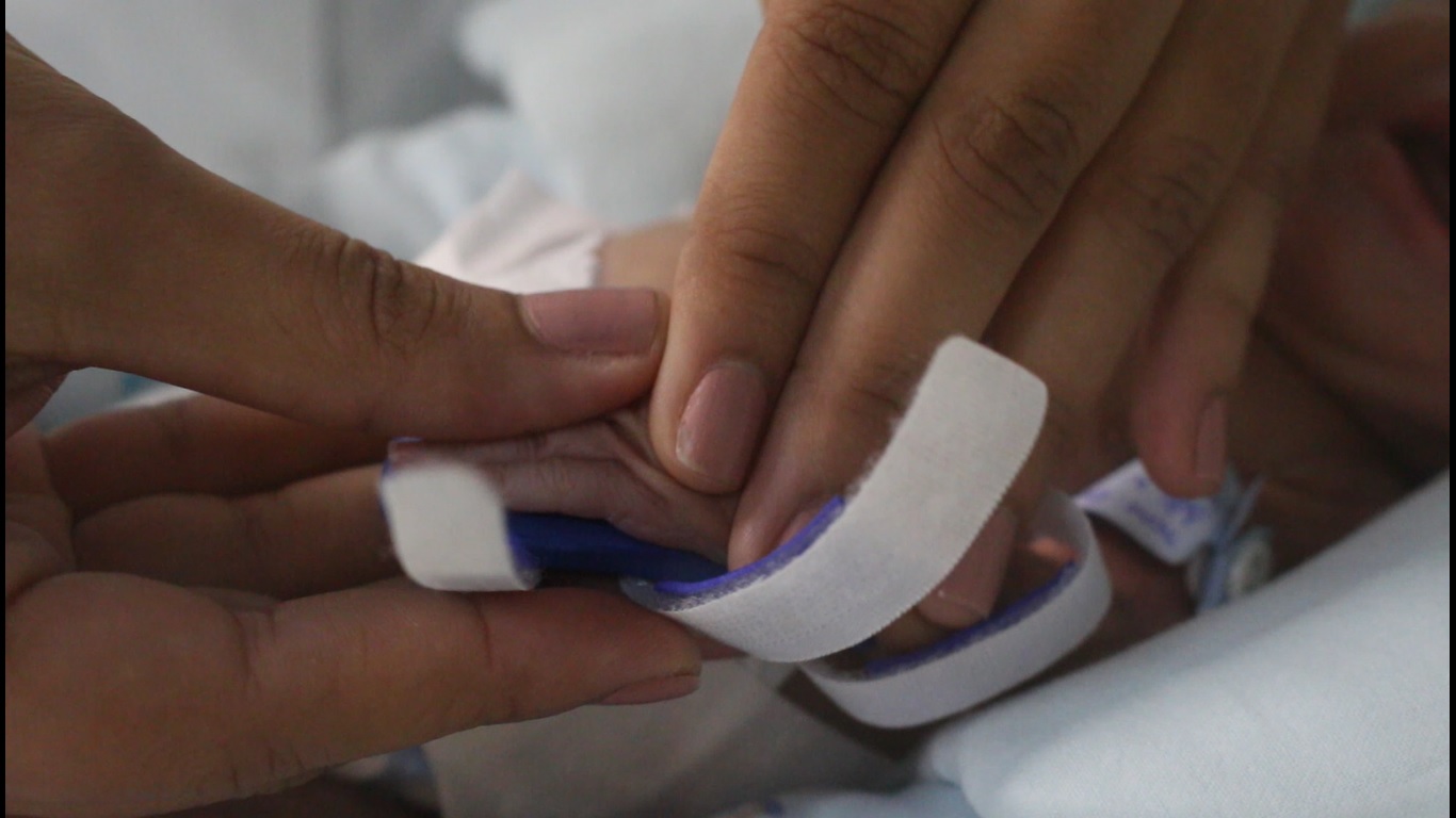 Posicionamento da órtese na mão do bebê- Pró-Saúde