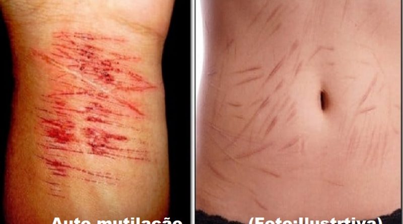 automutilação