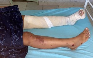 Leidiane de Jesus, de 29 anos, teve ferimento nas duas pernas (Foto: Jornal Folha do Progresso)