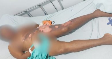 Mulher-queimada-780x384