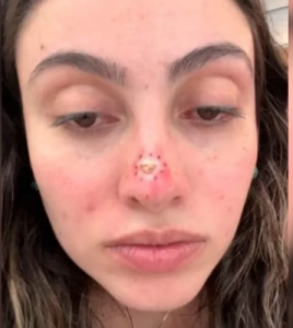 Após retirar sinal o nariz Juliana passou meses sem que a ferida cicatrizasse | Foto: Reprodução/Redes Sociais