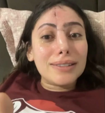 Jovem precisou fazer enxertos de pele na testa para reconstruir o nariz | Foto: Reprodução/Redes sociais