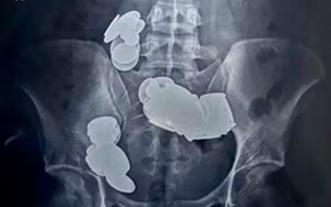 O jovem de 26 anos acreditava que ingerir moedas e ímas ajudaria na musculação (Foto: reprodução/Sir Ganga Ram Hospital)