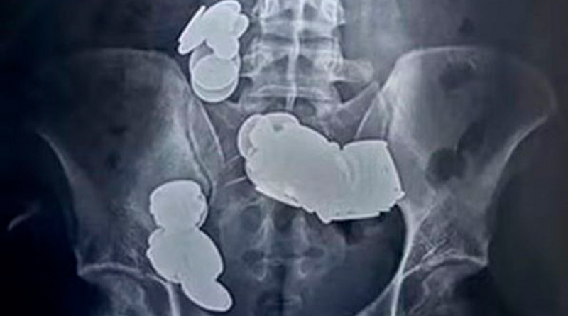 O jovem de 26 anos acreditava que ingerir moedas e ímas ajudaria na musculação (Foto: reprodução/Sir Ganga Ram Hospital)