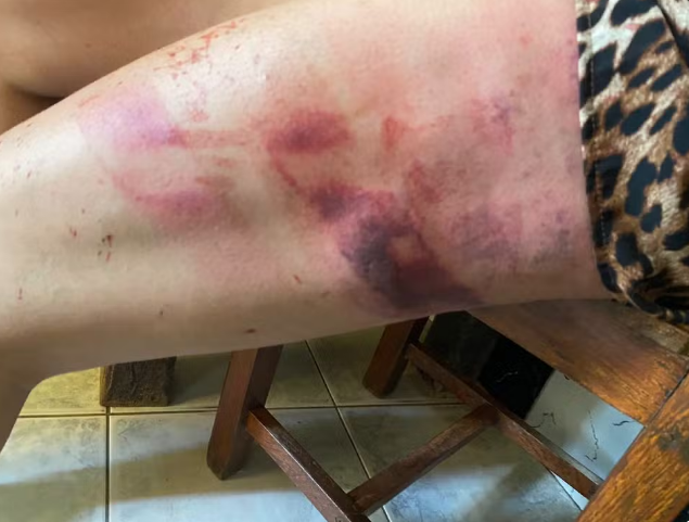 Marcas da violência sofrida pela mulher de 32 anos — Foto: Reprodução/Redes Sociais