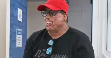 Ronaldo, portador de xeroderma pigmentoso, já passou por 230 cirurgias. Conheça sua história e a luta por qualidade de vida. | (Instituto Mais Identidade/Divulgação)