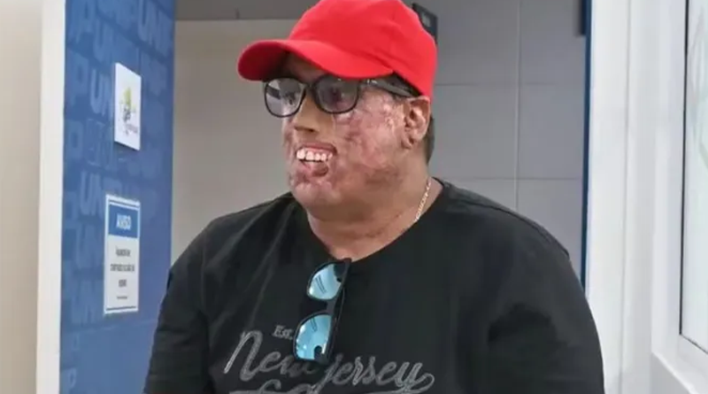 Ronaldo, portador de xeroderma pigmentoso, já passou por 230 cirurgias. Conheça sua história e a luta por qualidade de vida. | (Instituto Mais Identidade/Divulgação)