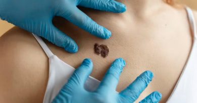 Melanoma-2_00928372_0_