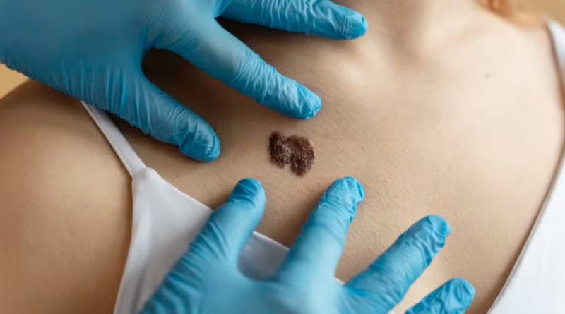 Melanoma-2_00928372_0_