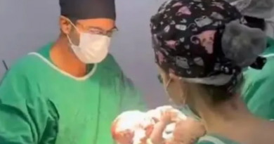 Caso bebês siameses-Jornal Folha do Progresso