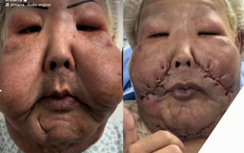 A trans Juju Fofão realizou a cirurgia para retirada do óleo mineral de seu rosto — Foto: Reprodução/Instagram