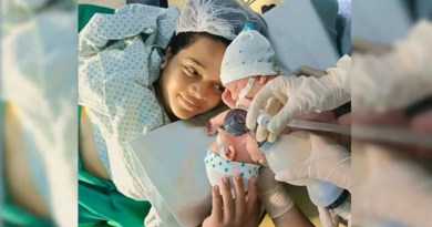 gemeos siameses-Jornal Folha do Progresso