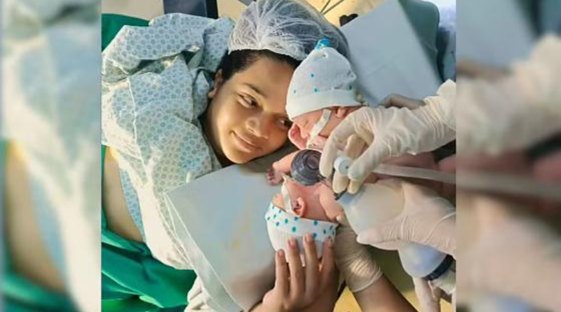 gemeos siameses-Jornal Folha do Progresso